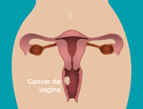 Cancer de ovarios endometrio utero vagina vulva tratamiento en Medellin4